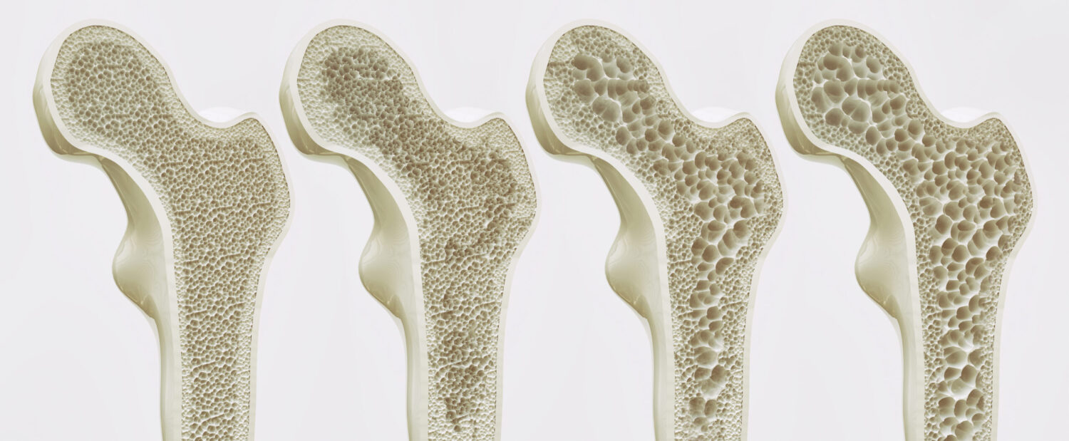 Osteoporose - knochengesunde Ernährung